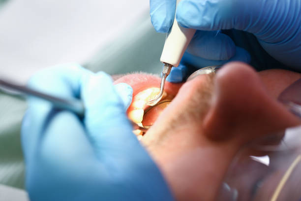 Best Emergency Tooth Extraction in Gervais, OR