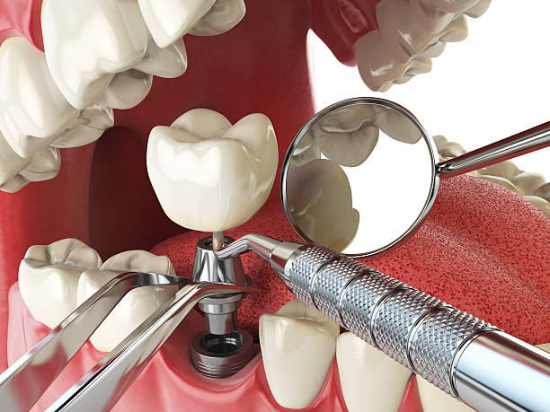 Best Urgent Care for Lost Fillings or Crowns in Gervais, OR
