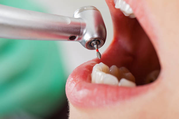 Best Emergency Wisdom Teeth Removal in Gervais, OR